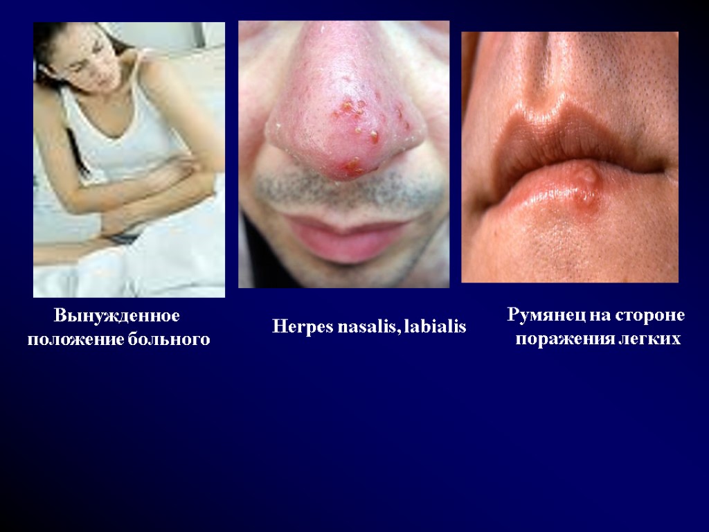 Вынужденное положение больного Herpes nasalis, labialis Румянец на стороне поражения легких